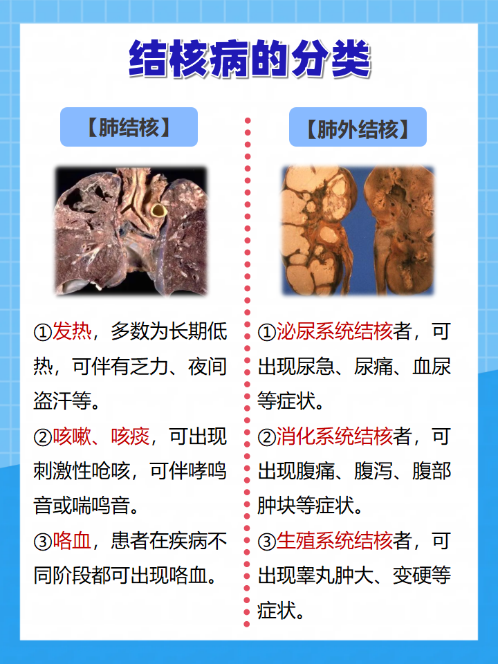肺结核传染途径有哪些