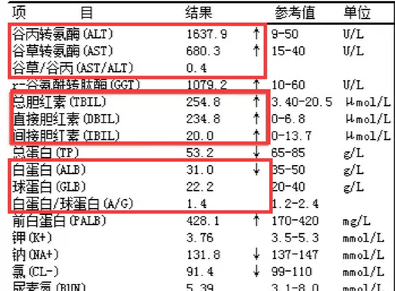 谷酰转肽酶高是肝癌吗?