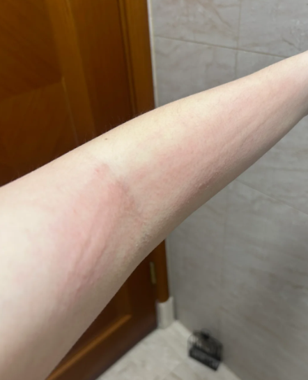 身上痒,一抓就是疙瘩