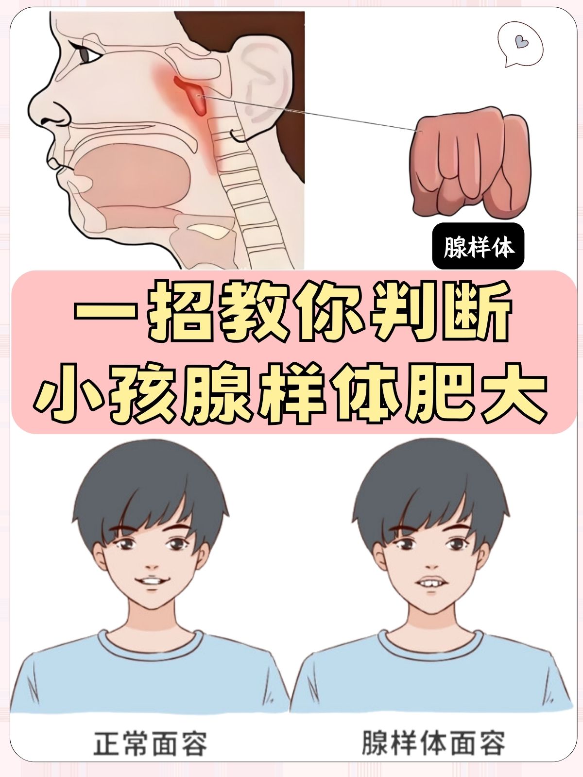 腺样体肥大有哪些表现