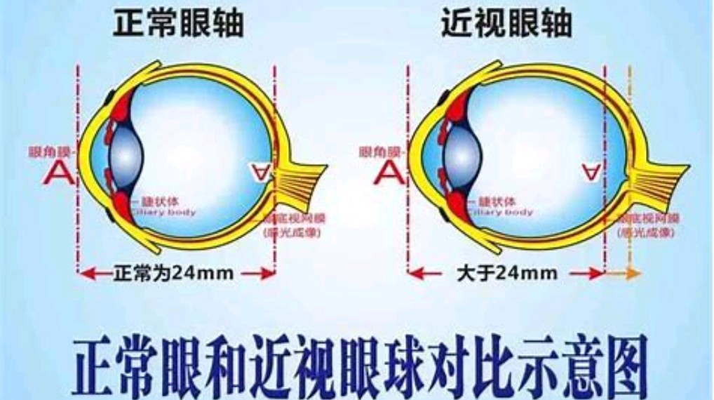 戴眼镜使得眼睛凹下去了