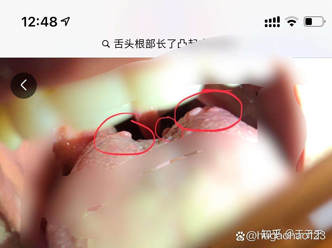 舌根有疙瘩,怎么回事