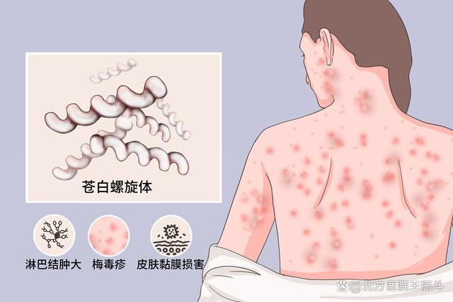 隐性梅毒会传染给别人吗