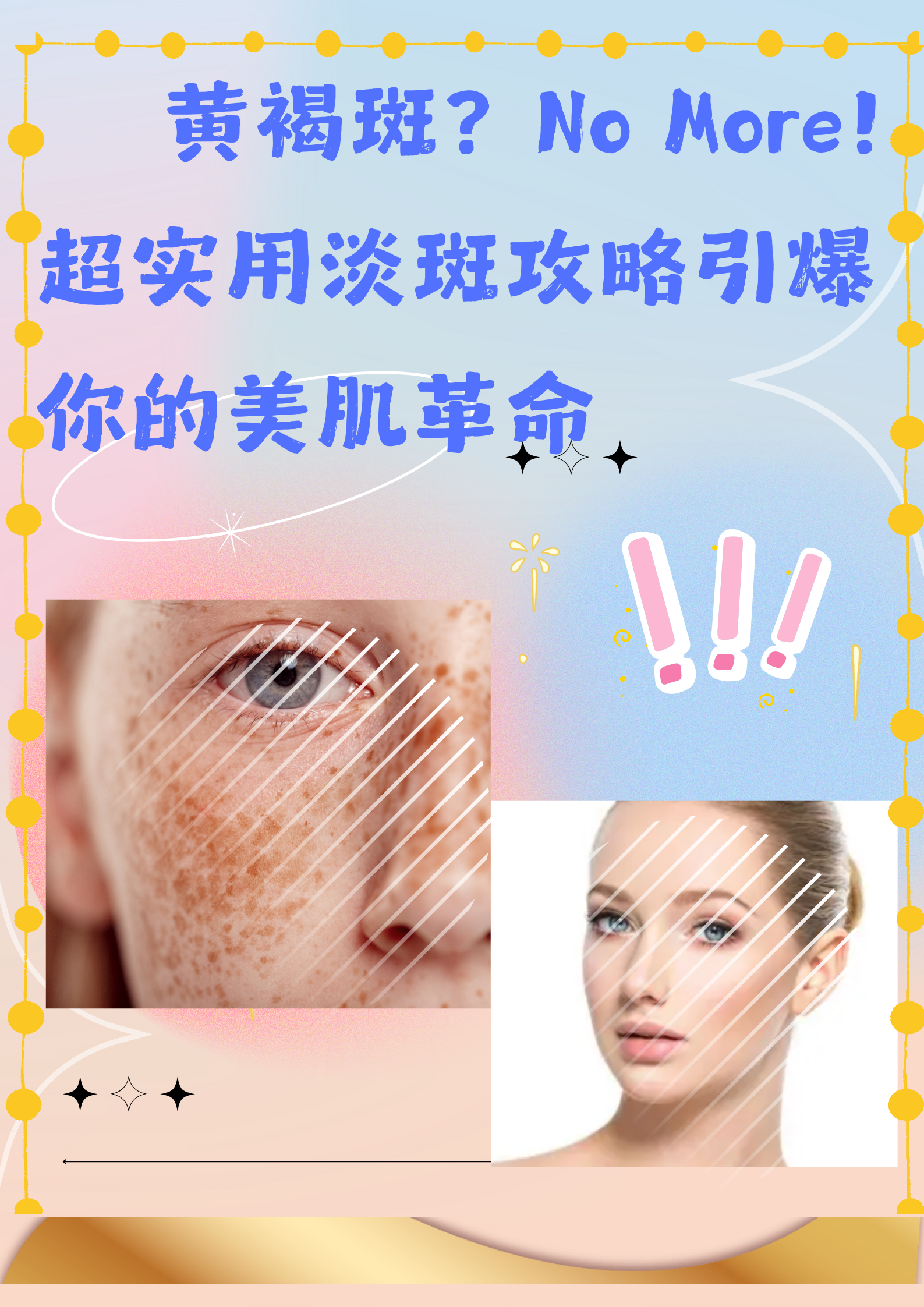 雀斑怎么去掉!