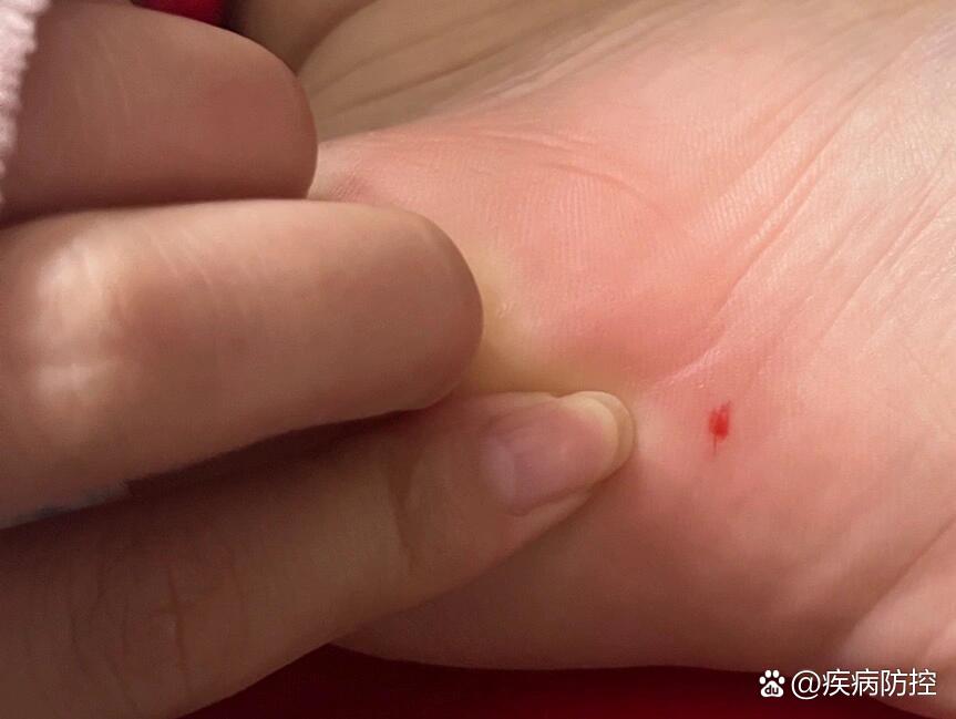 被钉子扎了破伤风概率高吗