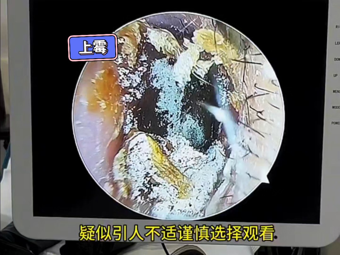 耳朵感染霉菌怎么办?