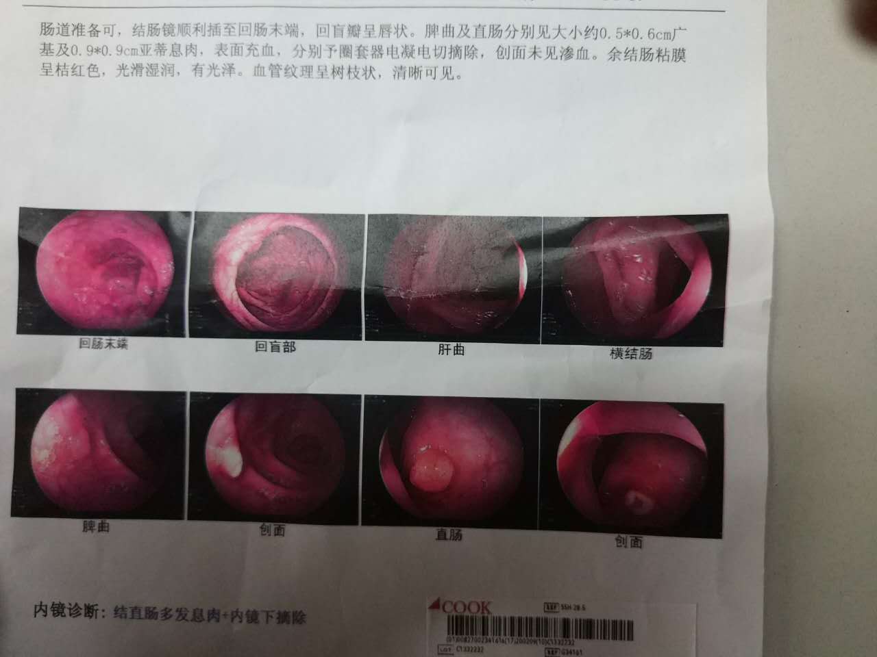 什么是回盲瓣溃疡