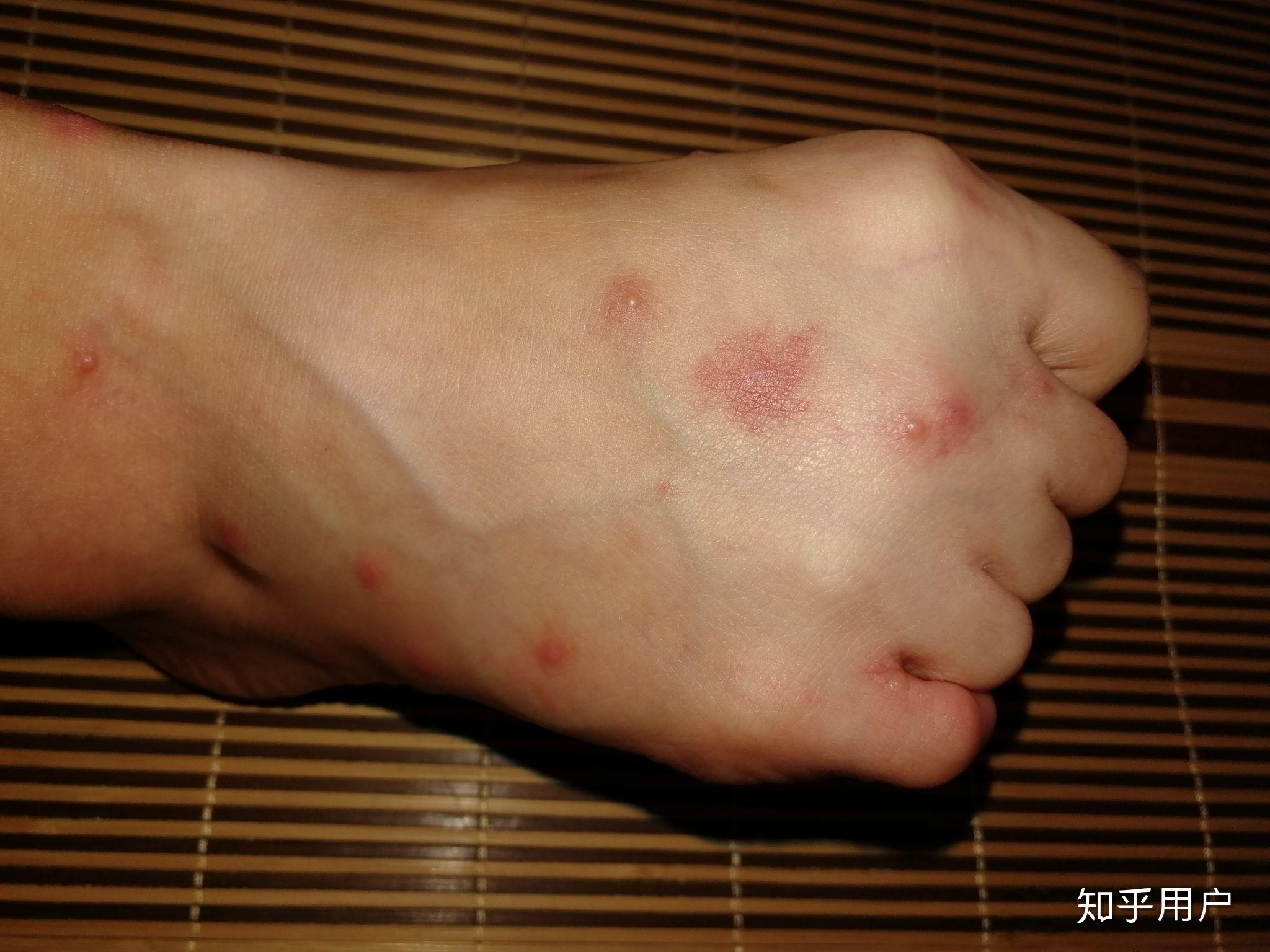 跳蚤爱咬什么样的人