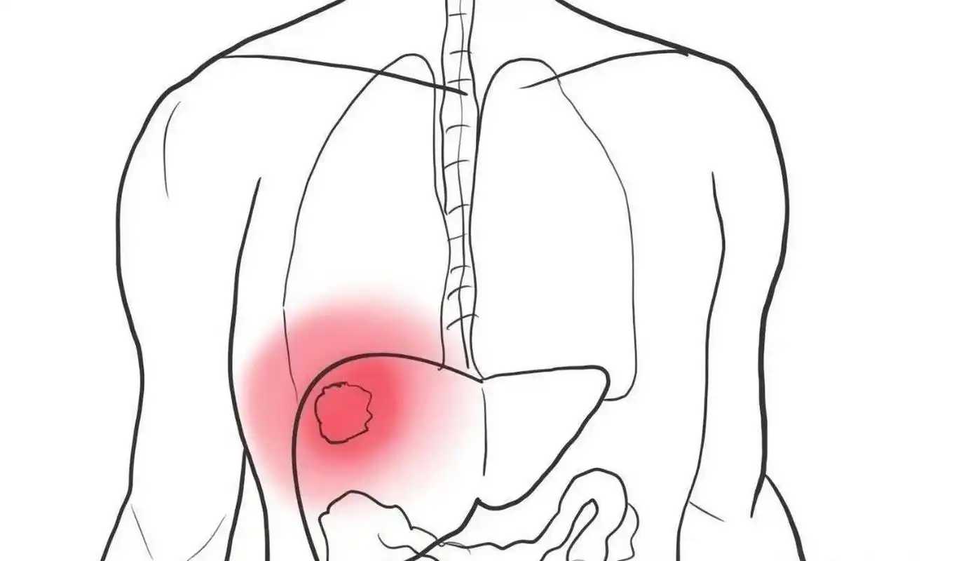 肝区疼痛一定是肝炎吗?