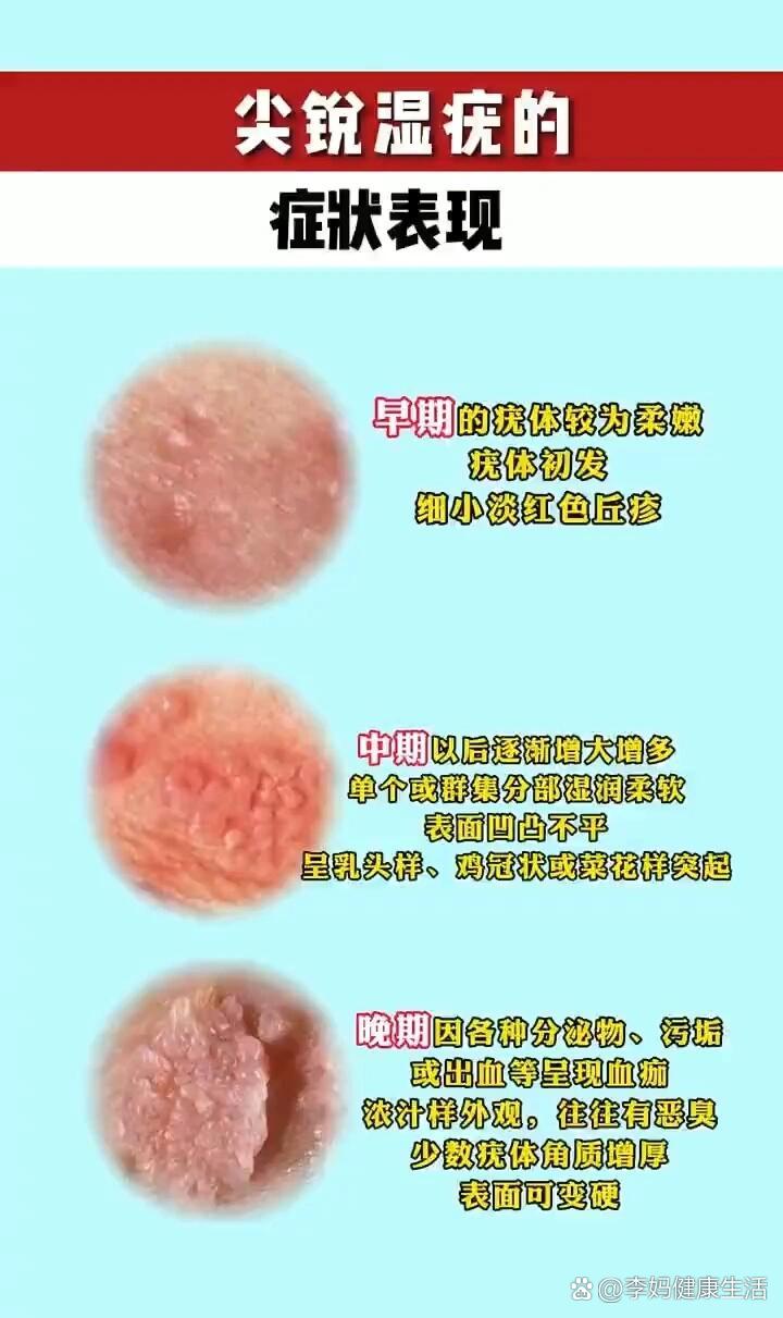 尖锐湿疣是怎么引起的?