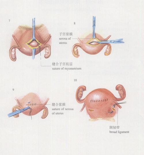 子宫肌瘤剔除术