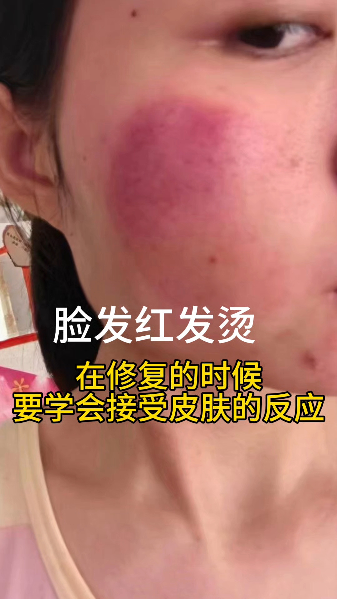 脸部发烫是怎么回事