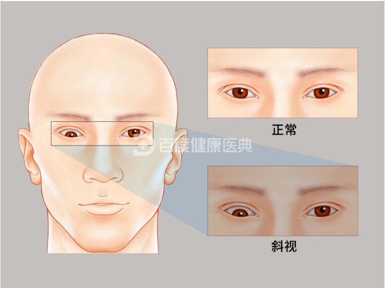 斜视形成的原因是什么