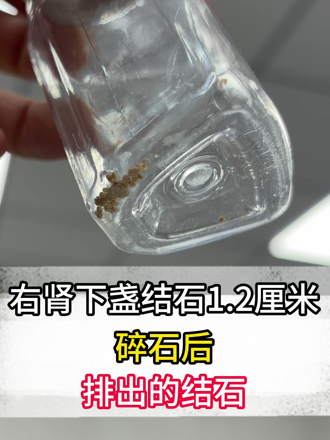 肾结石能体外碎石吗?