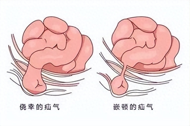 疝气严重吗