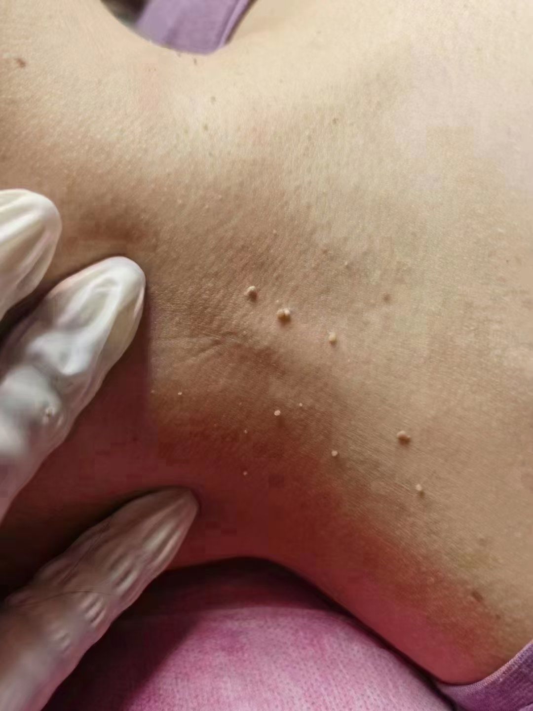 扁平疣的症状表现