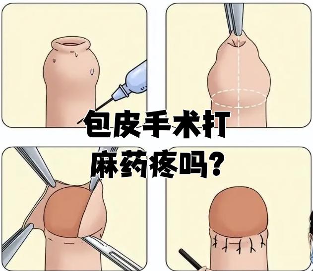 打局部麻醉时疼吗