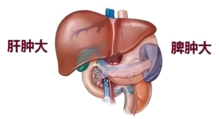 脾大的治疗方法
