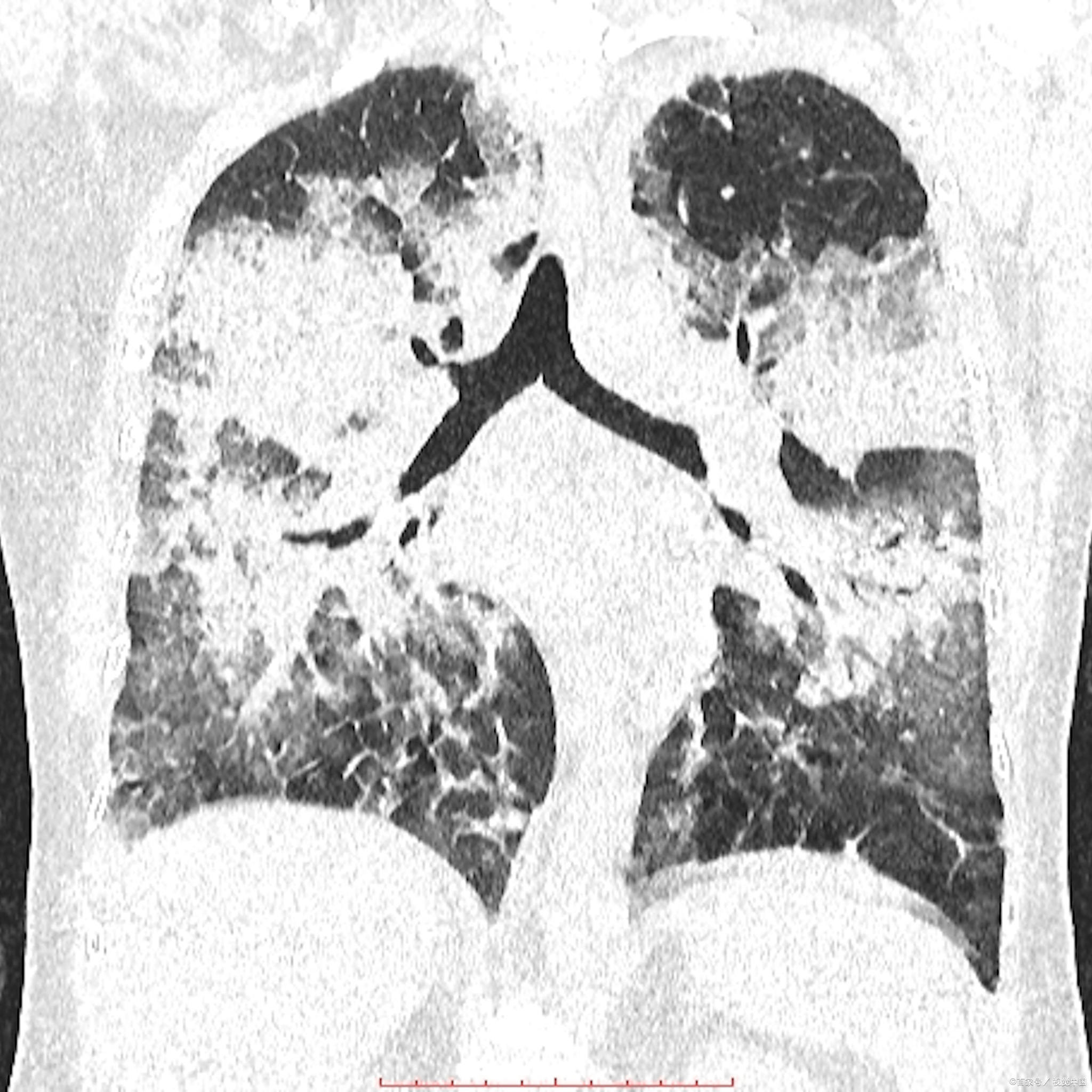 肺纤维化的症状