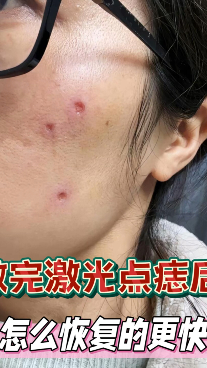 激光点痣后多久可以正常洗脸?