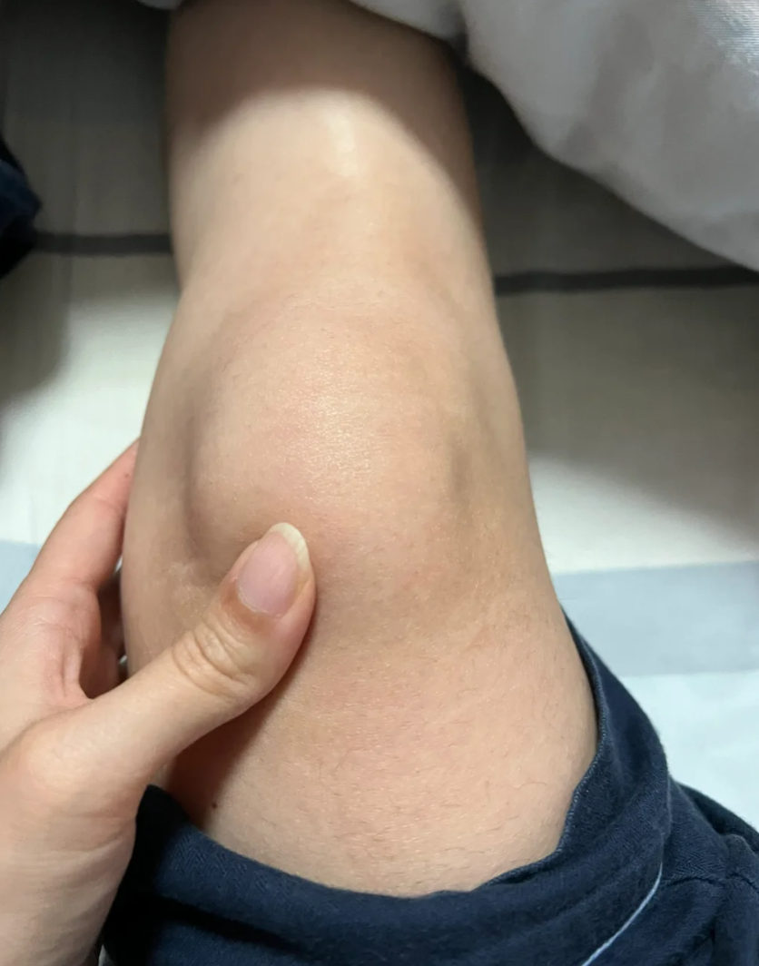膝盖半月板损伤有哪些症状?