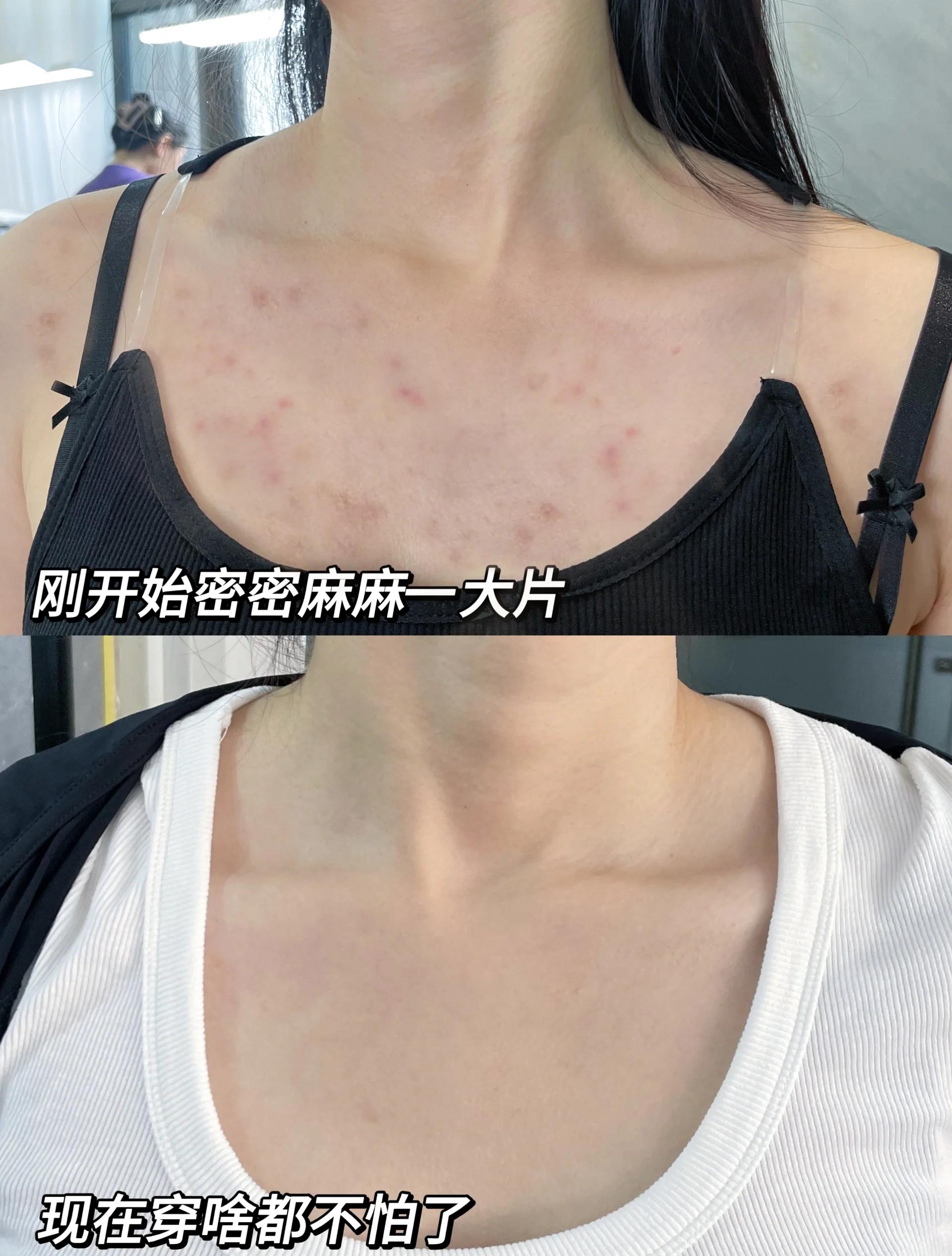 胸前长痘痘是什么原因