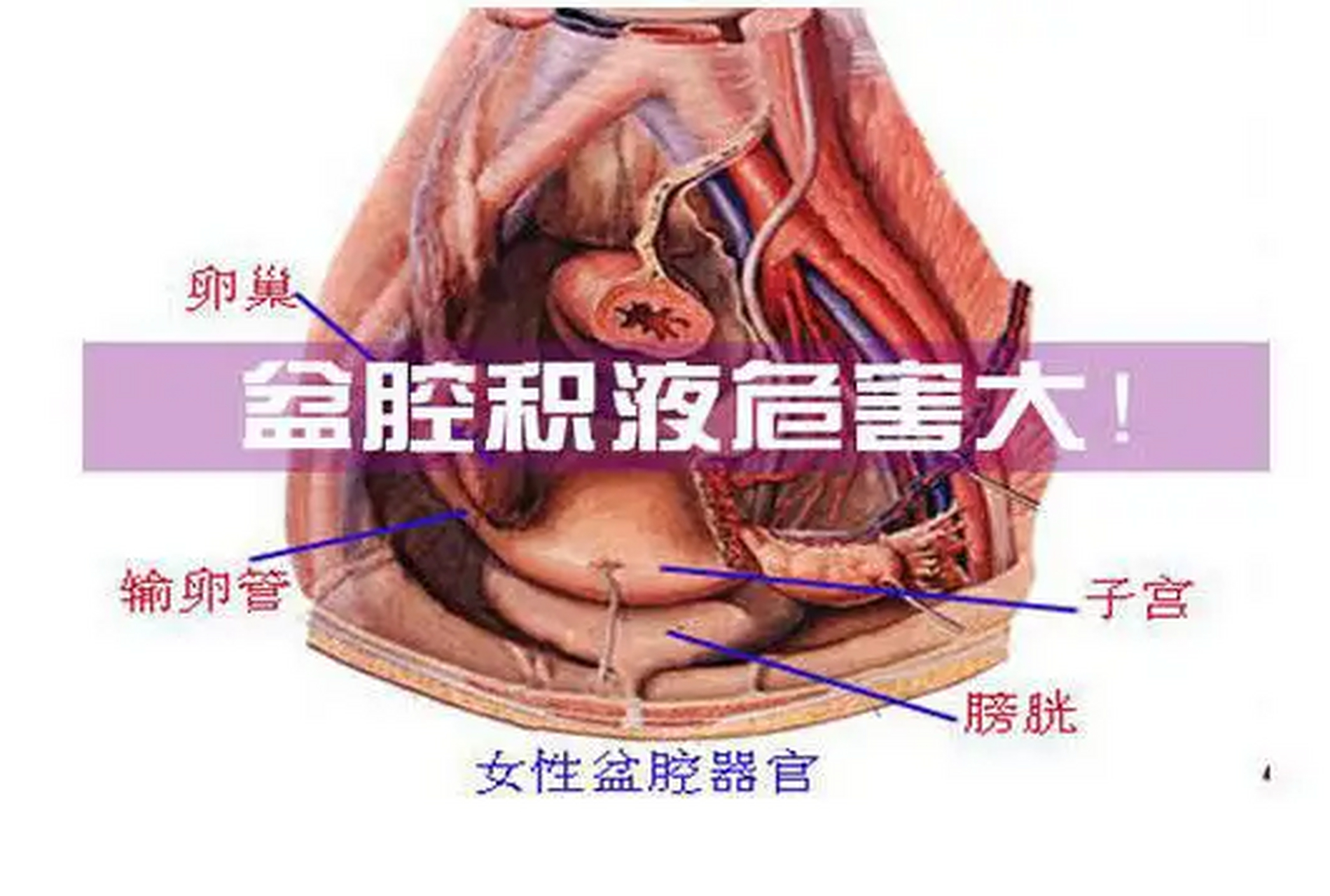怀孕盆腔积液什么意思