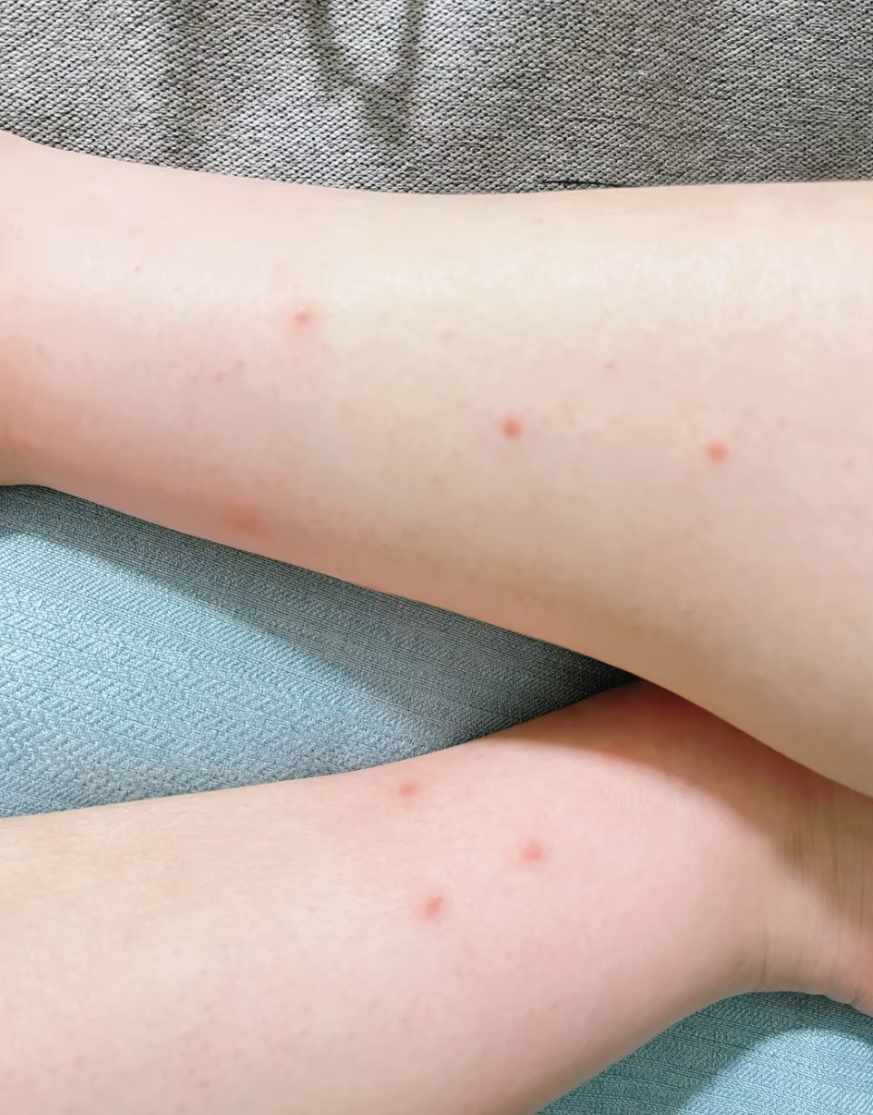 身上长红点,很痒,怎么回事