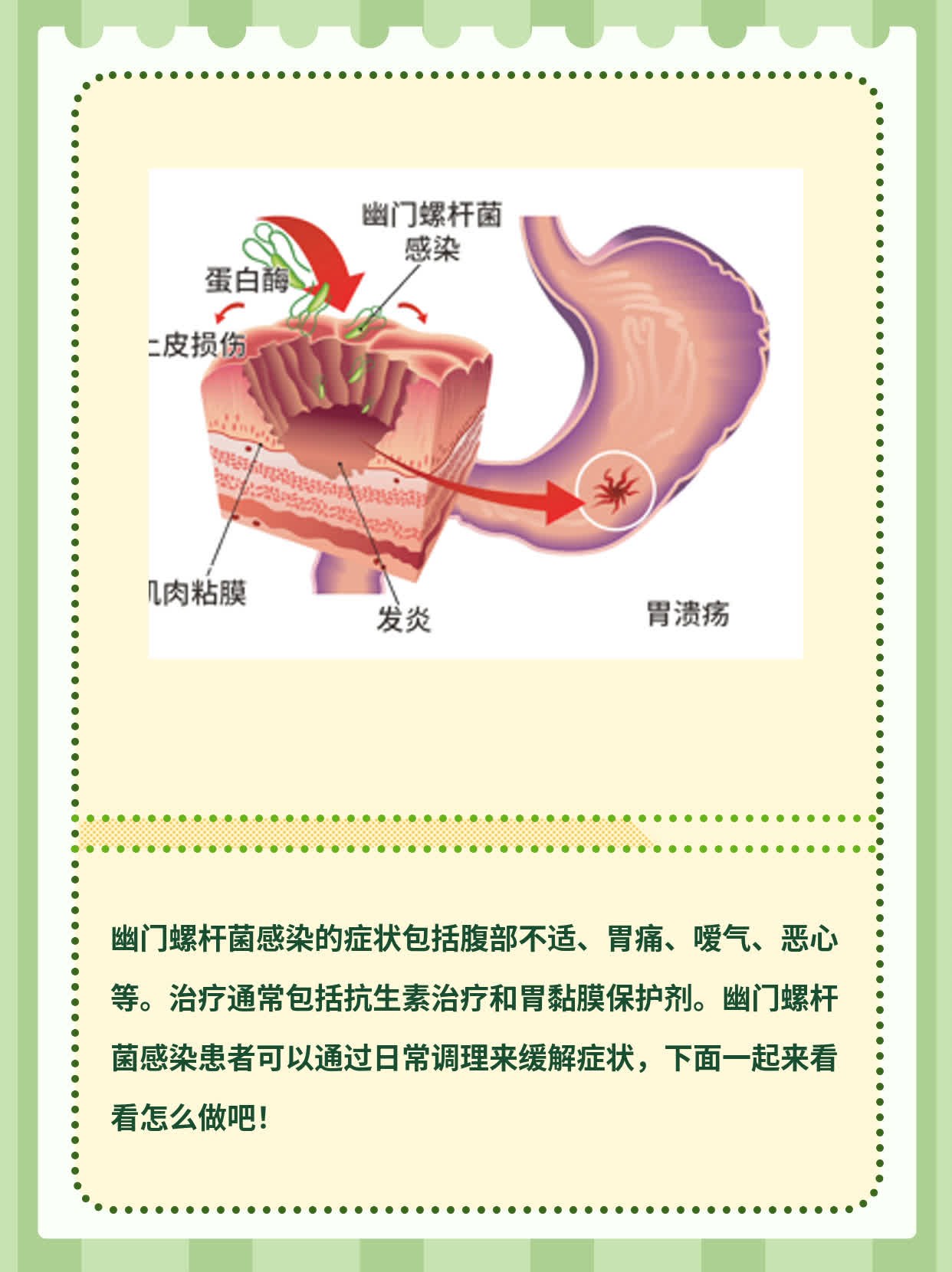幽门螺杆菌的治疗方法