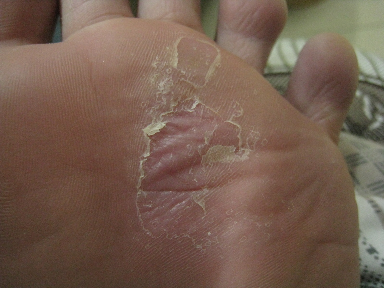 脚底有一块白色的像厚皮一样的东西