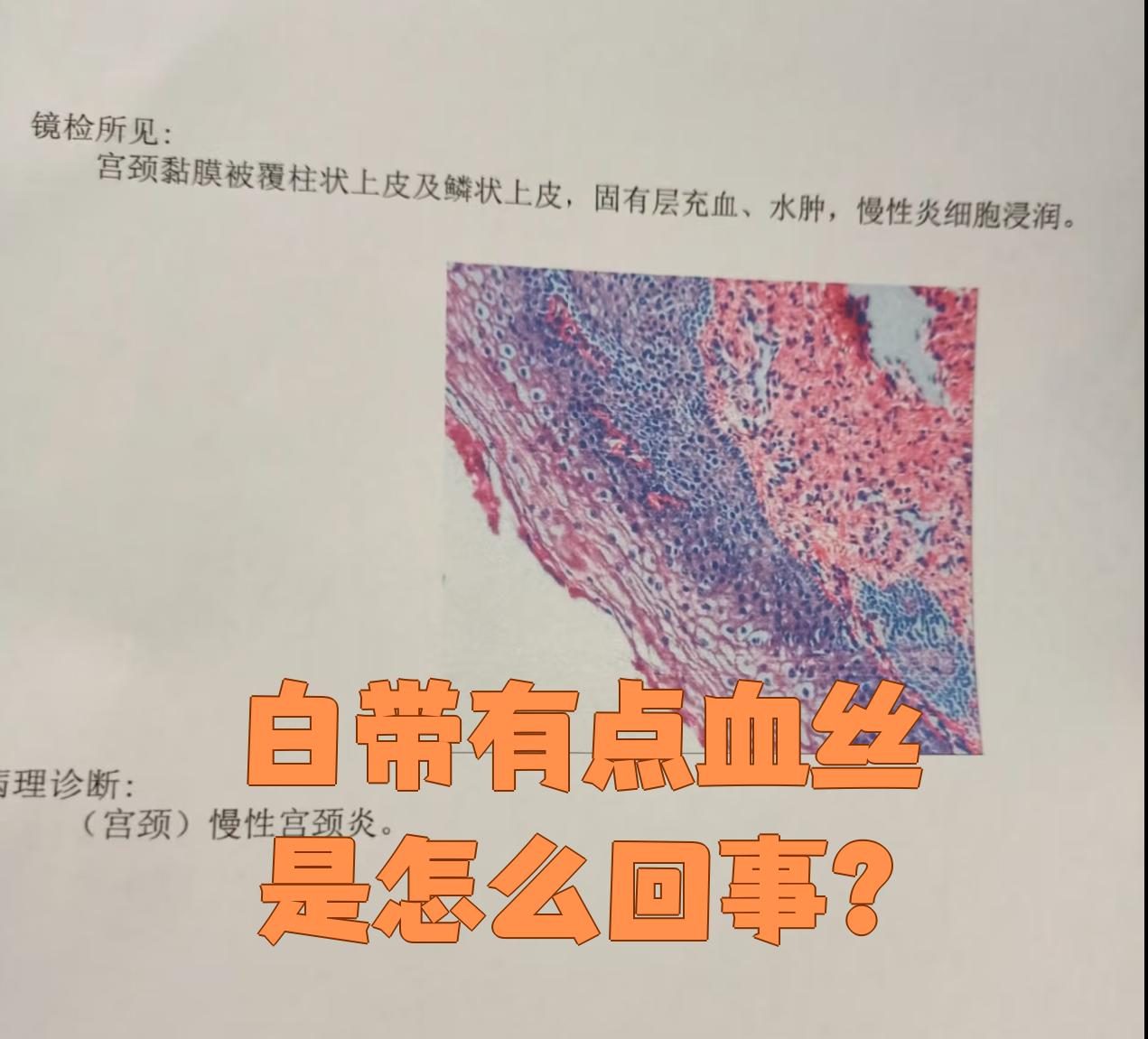 出现血性白带怎么办