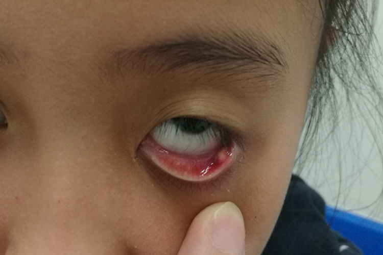 眼角肿了个包是麦粒肿吗