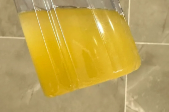 尿液浑浊发黄