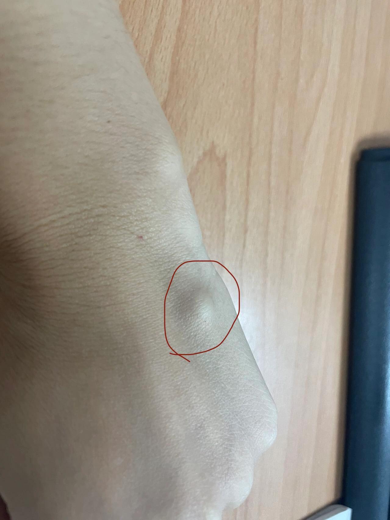 腱鞘囊肿可以自愈吗