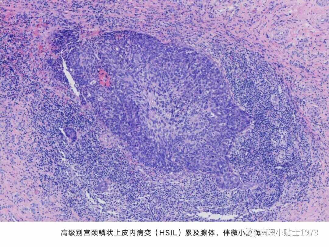 宫颈鳞状细胞癌严重吗