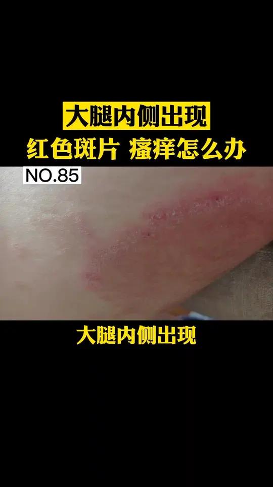 大腿根内侧瘙痒怎么办
