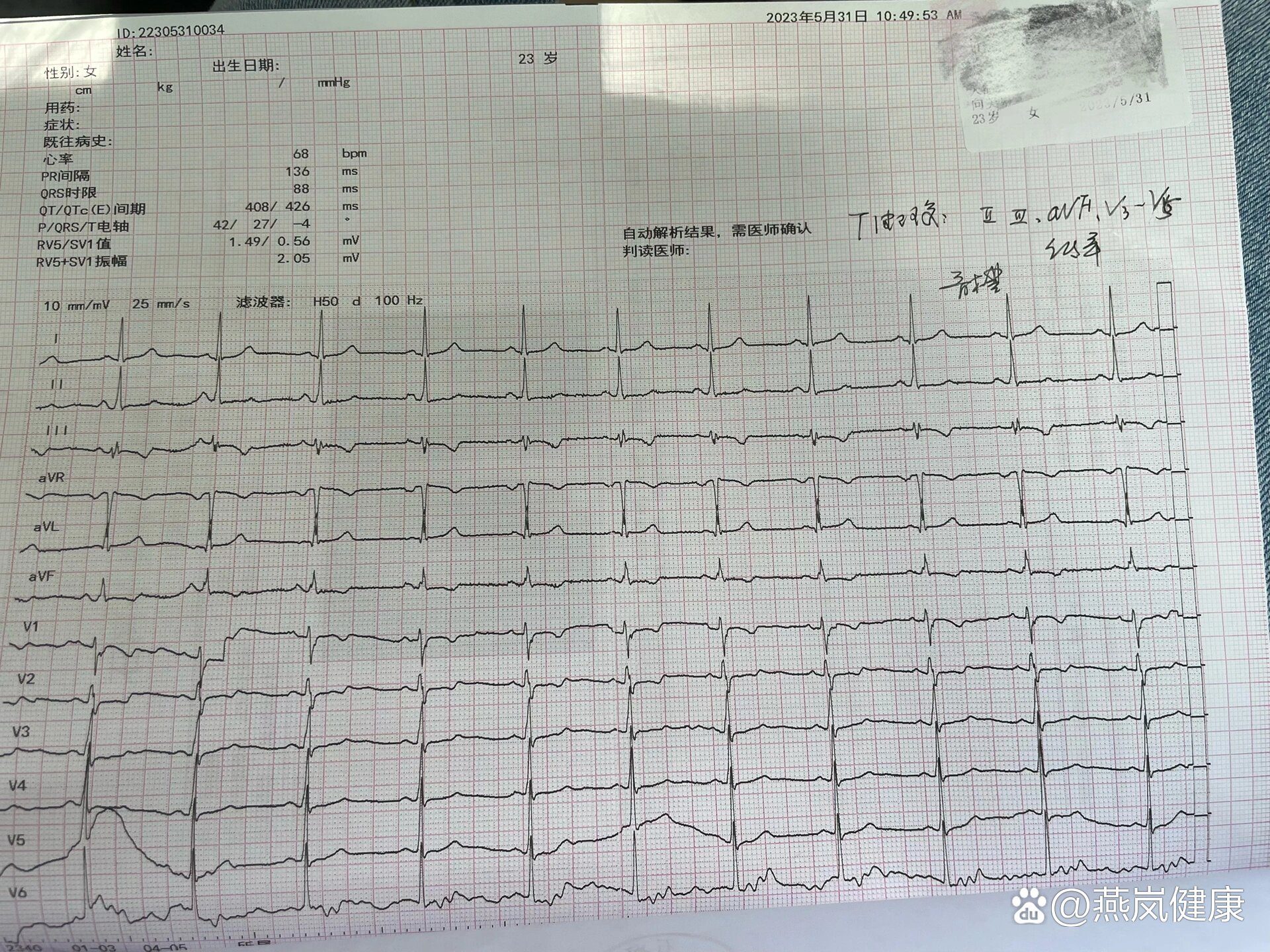 非特异性t波异常怎么回事