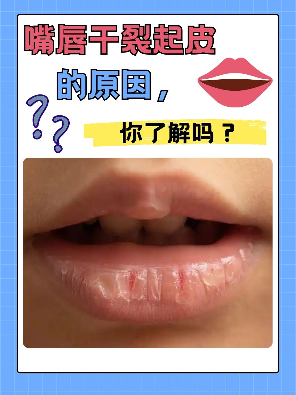 嘴唇起皮是什么原因?