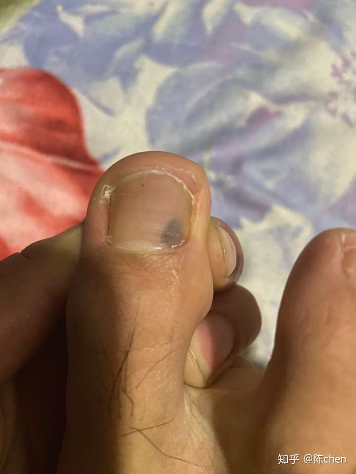 脚趾甲变黑