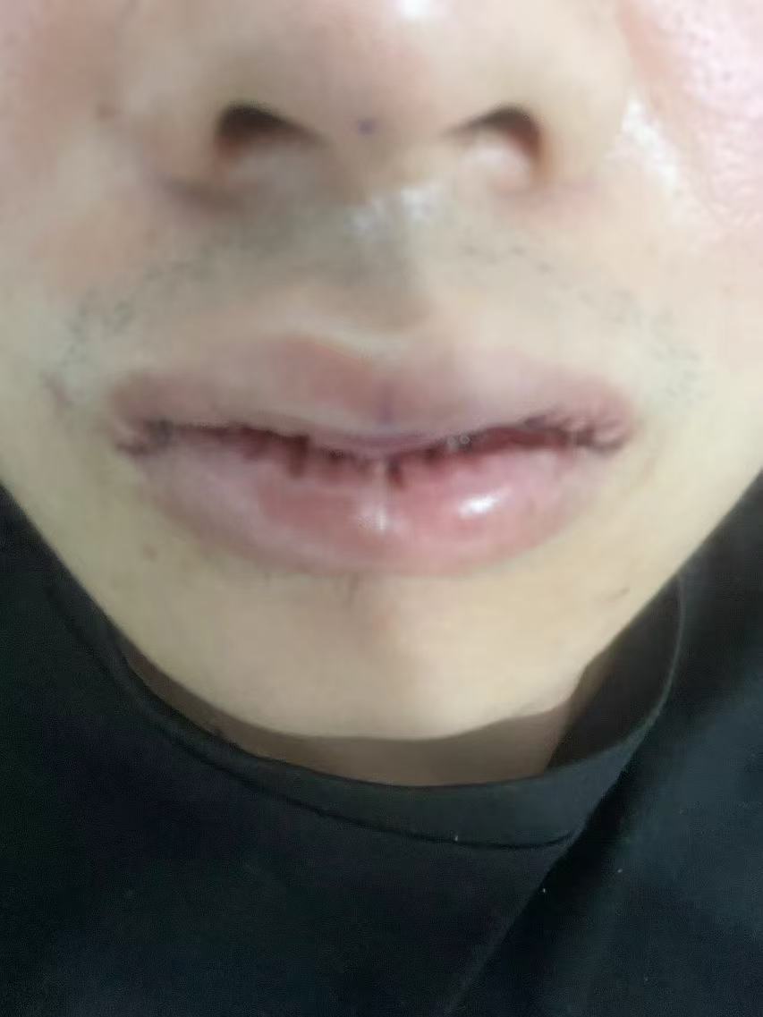 今天是唇部改薄手术后17天
