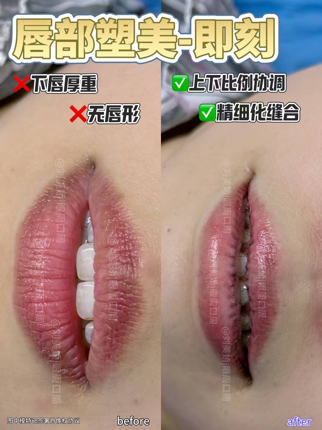 今天是唇部改薄手术后17天