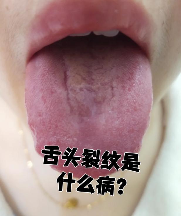 舌头上有裂缝是什么病？