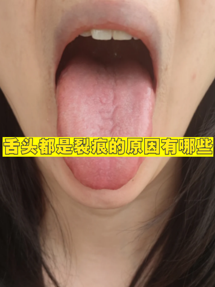 舌头上有裂缝是什么病?