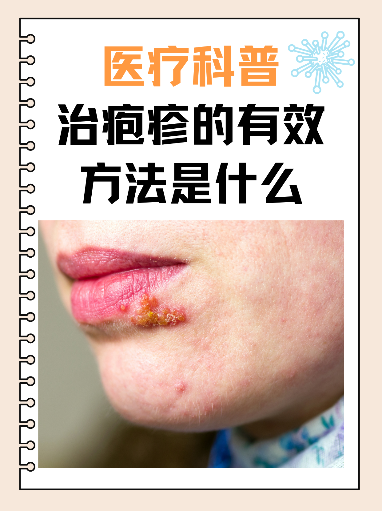 小儿疱疹的治疗