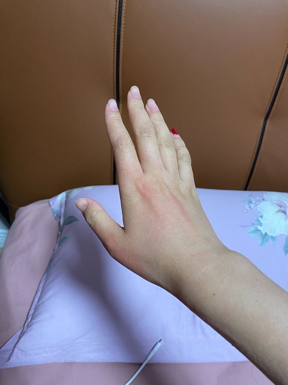 甲亢症状表现