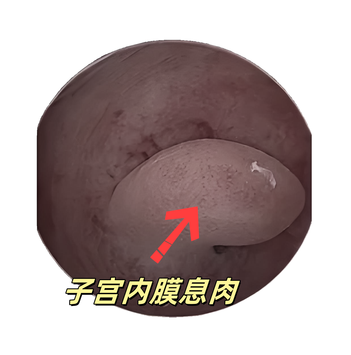 宫颈息肉的症状有哪些