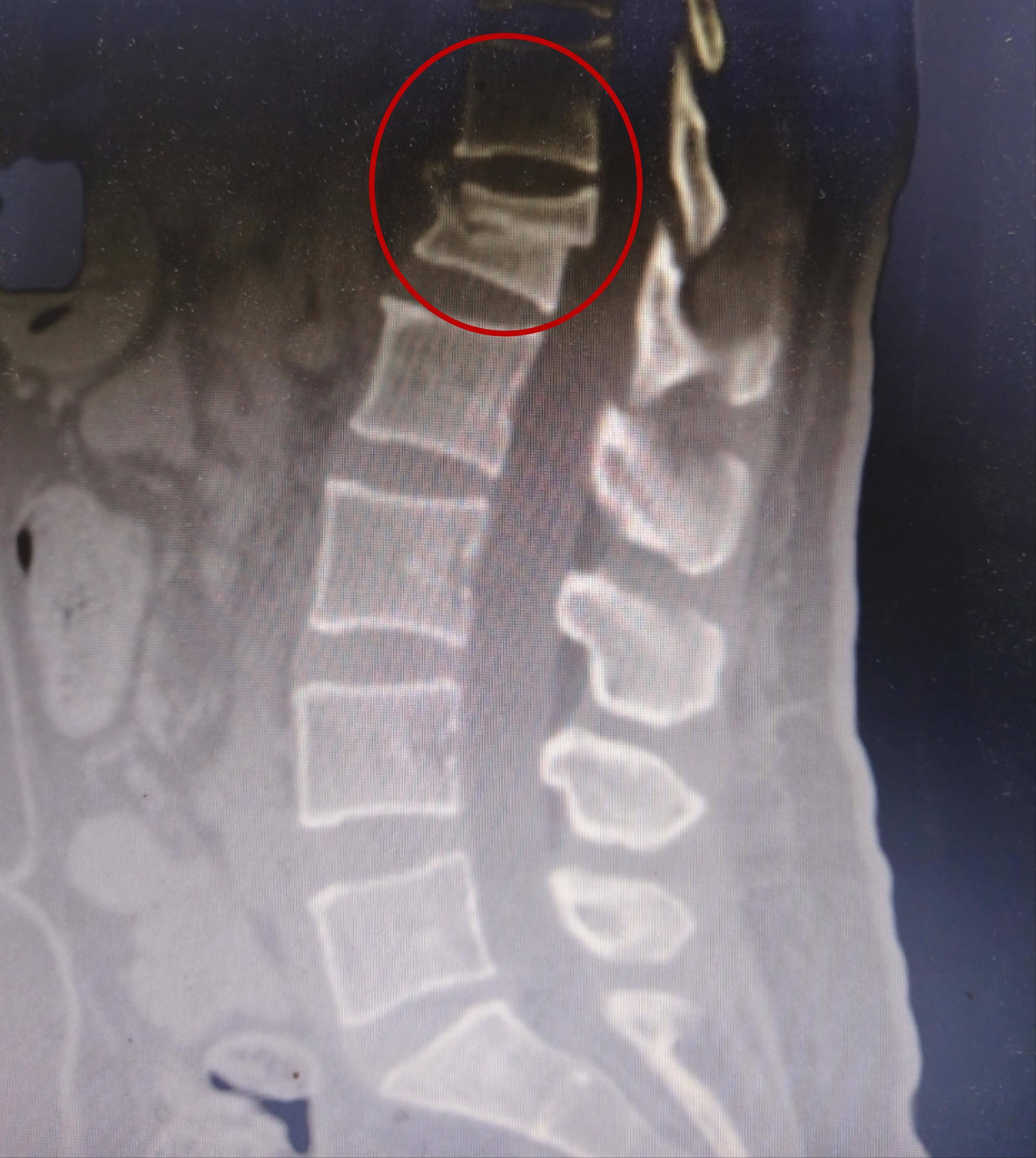 腰椎骨折多久可以下床?