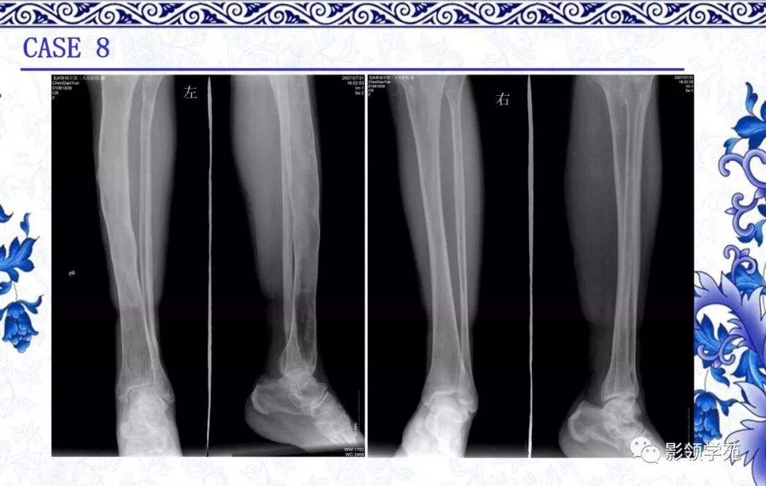 骨纤维结构不良的定义