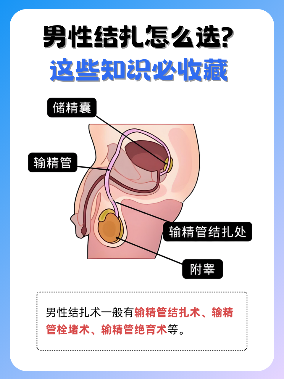 精索静脉高位结扎术是什么