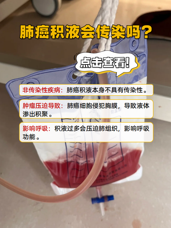 肺癌能传染吗